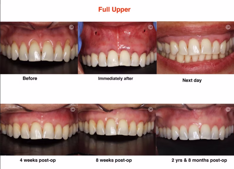 full upper