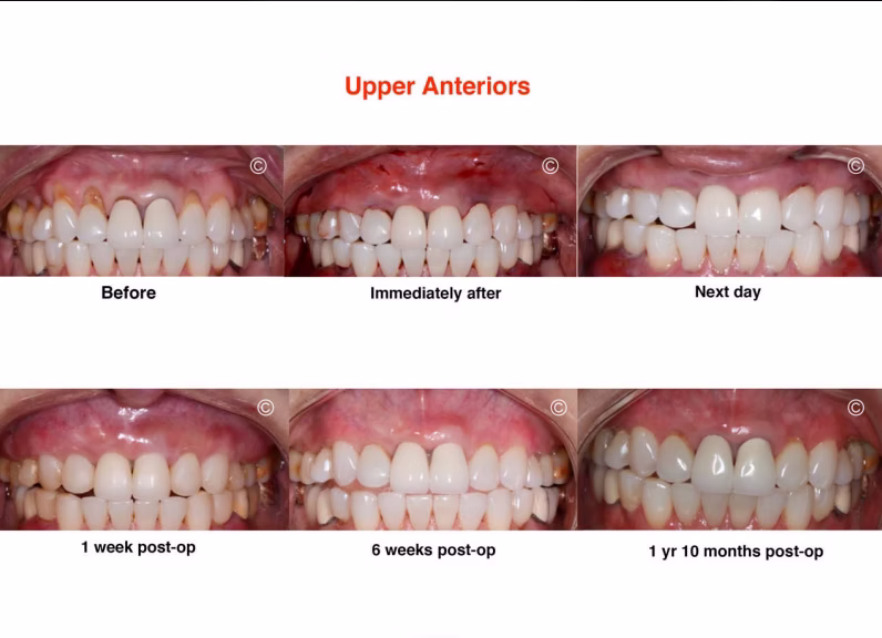 3_upper_anteriors